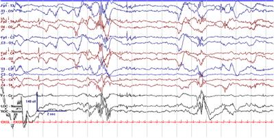 Current and Future Uses of Continuous EEG in the NICU